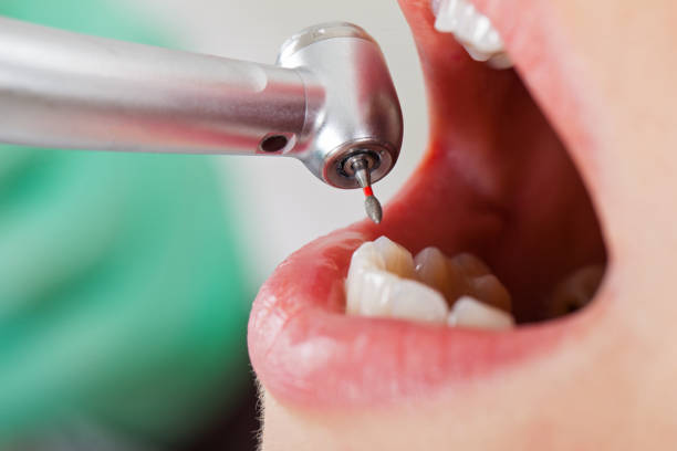 Best Emergency Treatment for Dental Infections or Abscesses in Garden Acres, CA